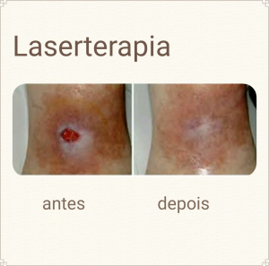 Laserterapia